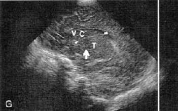 caudothalamic groove ultrasound